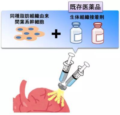 日本大阪大學(xué)研發(fā)出救治心衰患者的干細(xì)胞噴霧